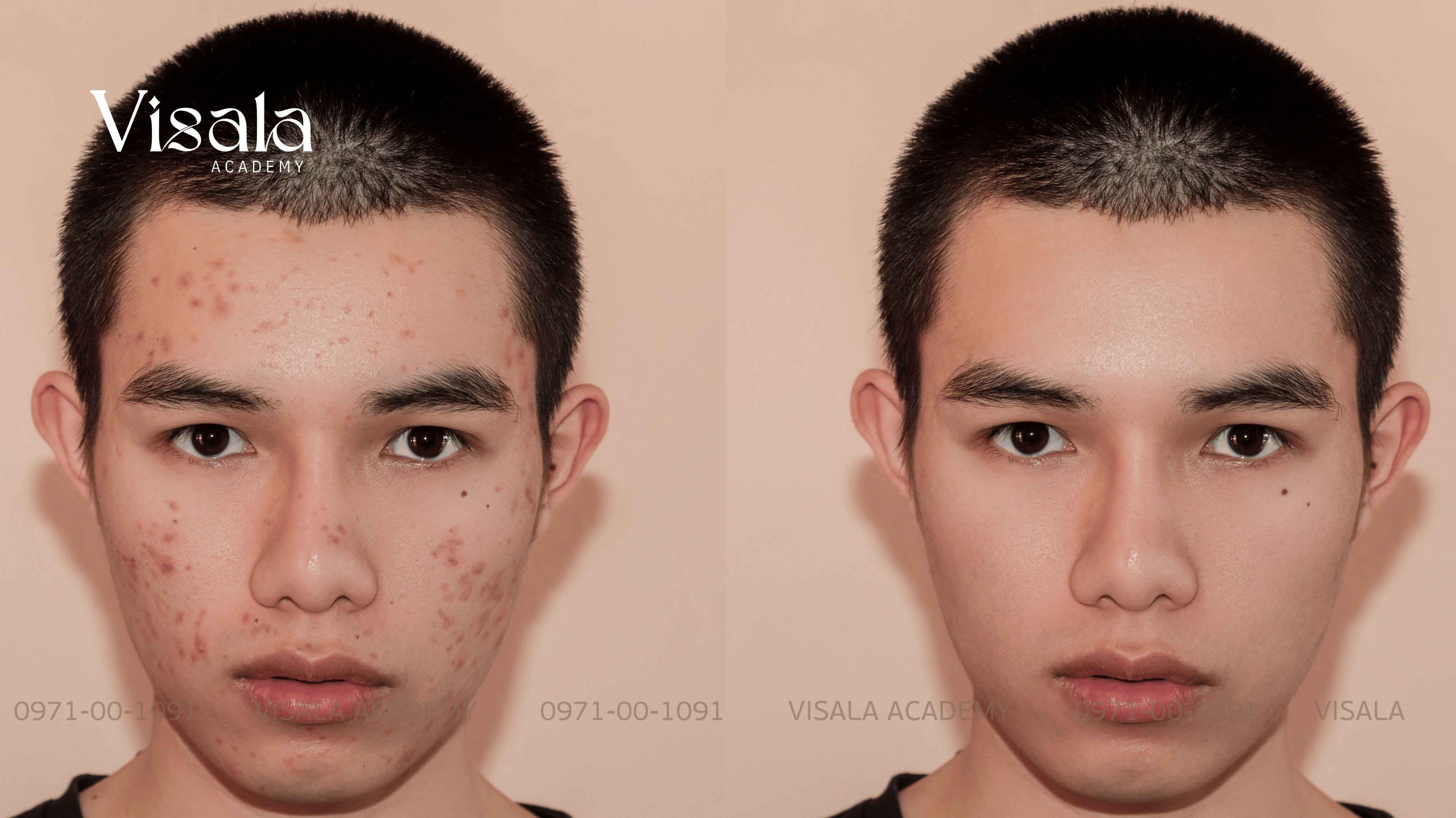 Liệu pháp tẩy da chết cơ học (microdermabrasion)